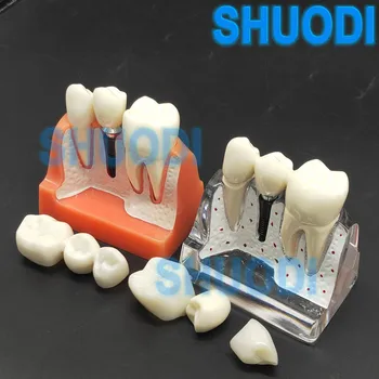 4 Kartus Dantų Dantų Mokymo studijų Modelį, Dantų Implantai Ligos Analizė, Restauravimo Karūna Tiltas Demonstravimo